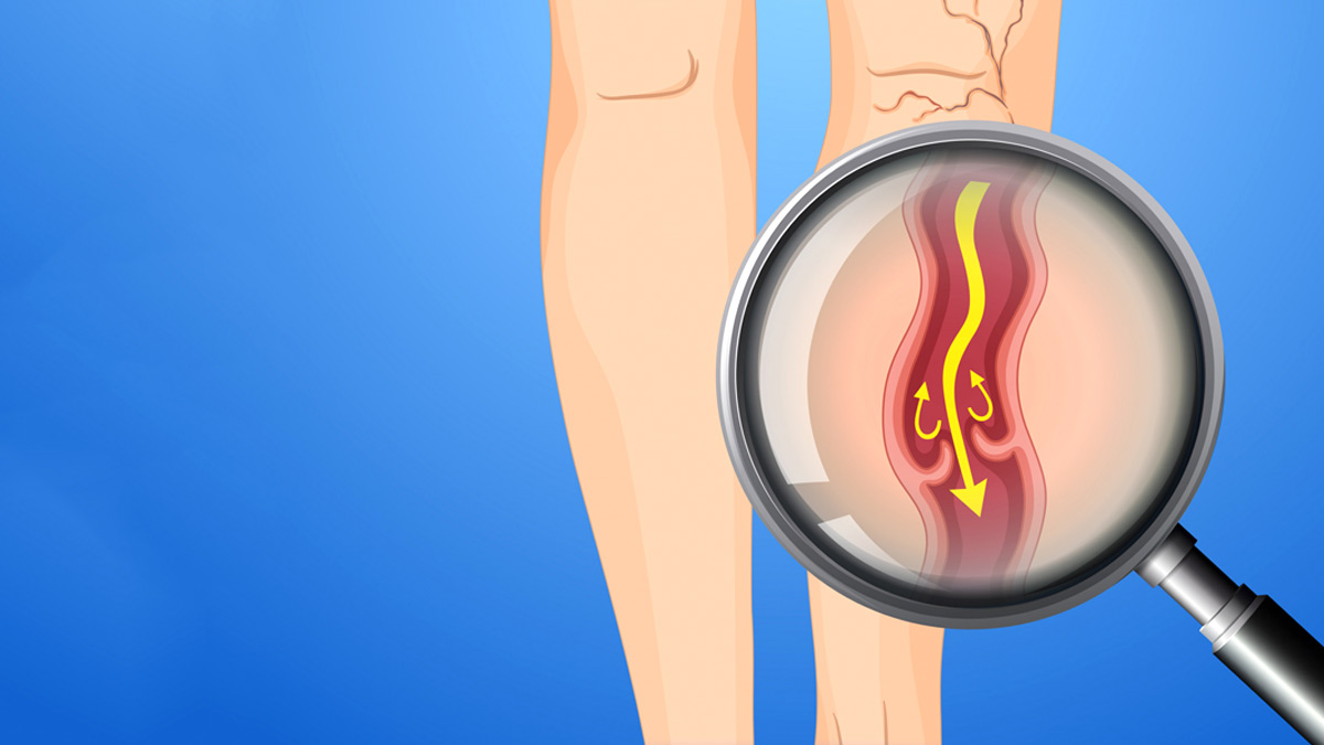 inside1-varicoseveinsproblems