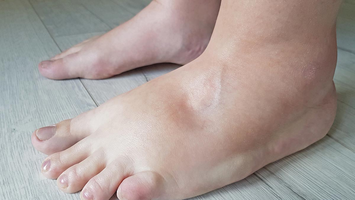When Swelling Isn’t Just Water Retention: Kidney Clues Most People Miss