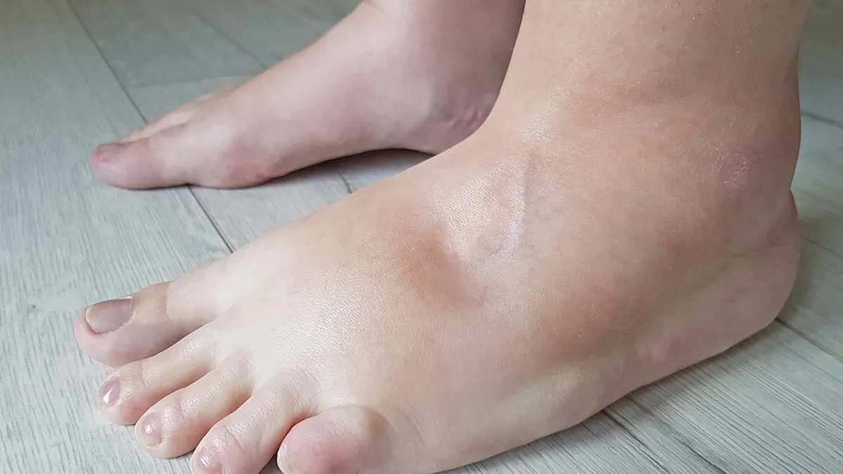 When Swelling Isn’t Just Water Retention: Kidney Clues Most People Miss