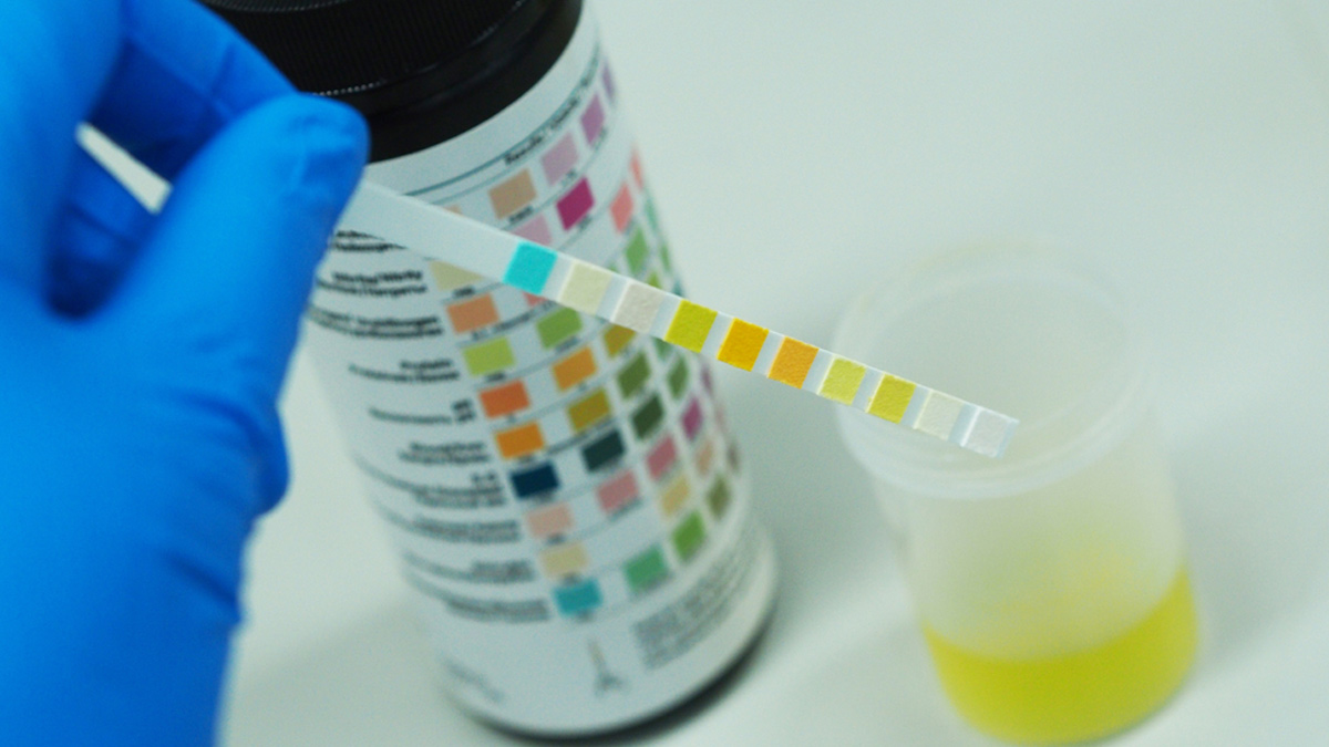 urine-dipstick-test