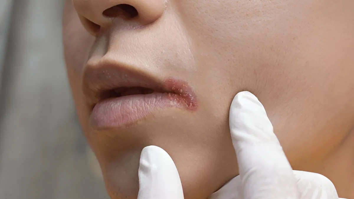 Why Cracks At The Corners Of Your Mouth Could Mean A Vitamin Problem