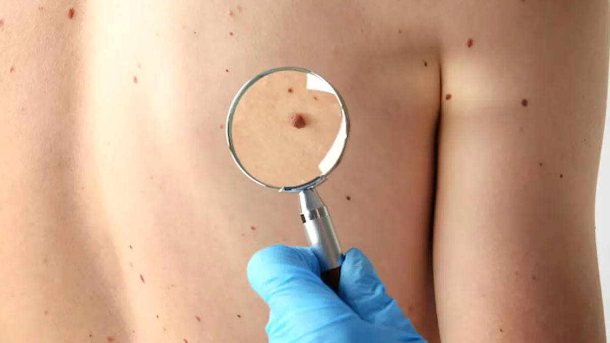 Mole Or A Birthmark? Understanding The Differences And Why It's Important To Know