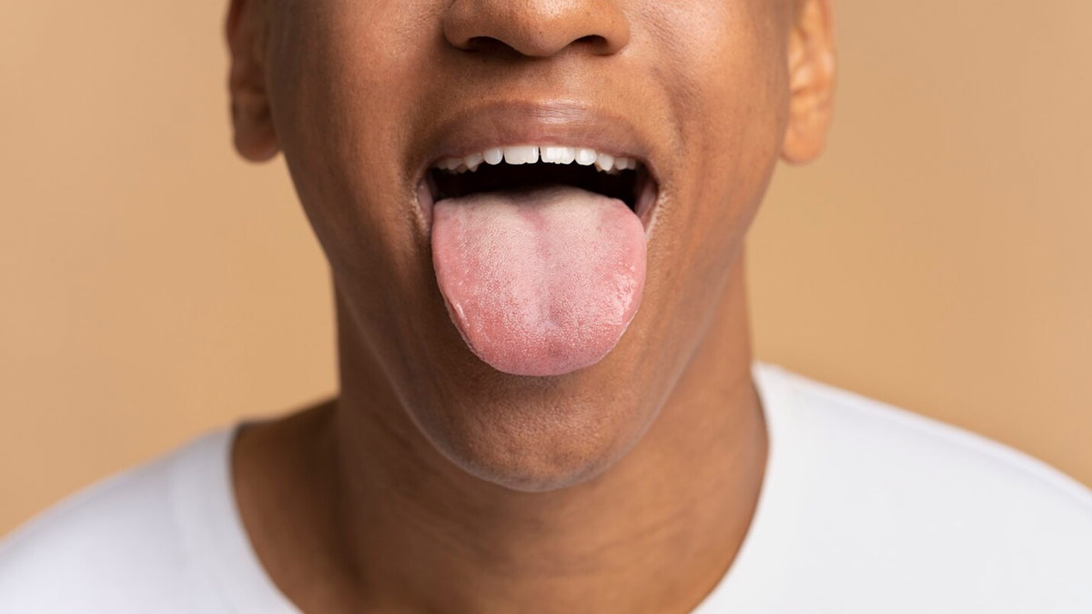 Why Tongue Cancer Risk Isn’t Just About Tobacco