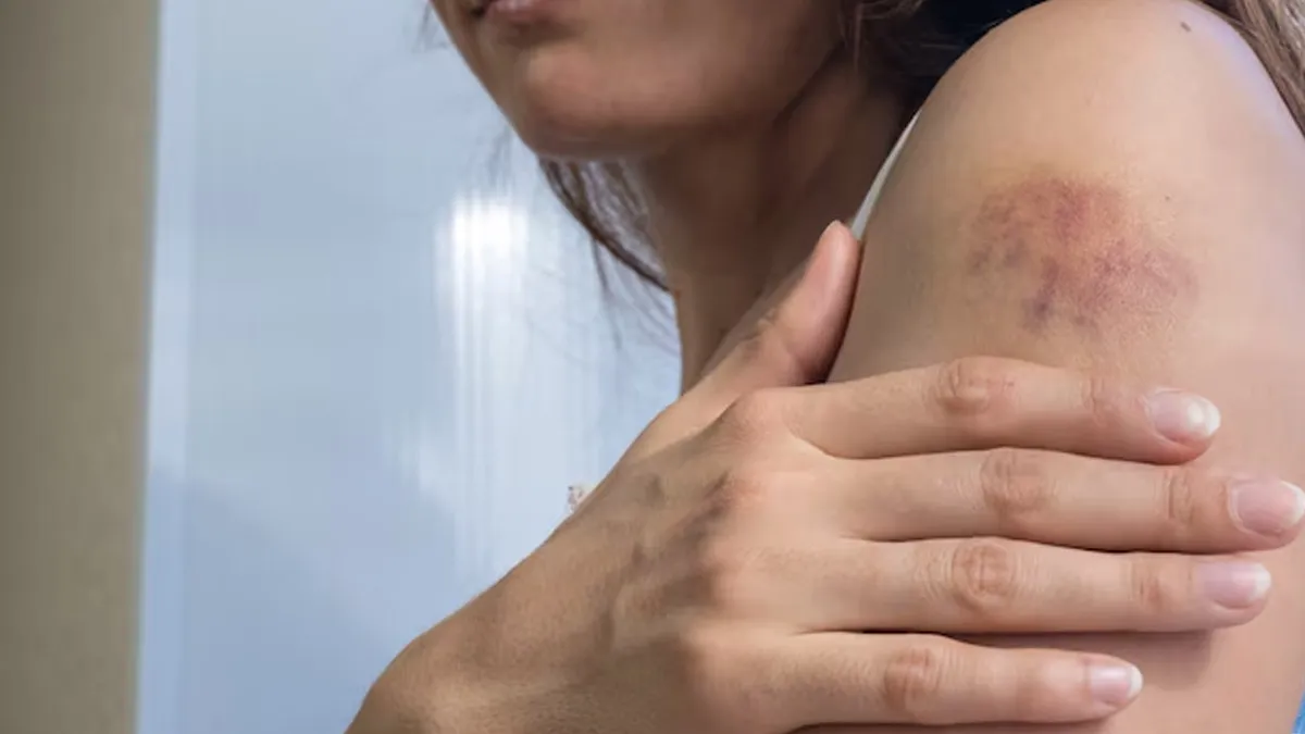 "I See Random Bruises On My Body" - What Could It Mean?