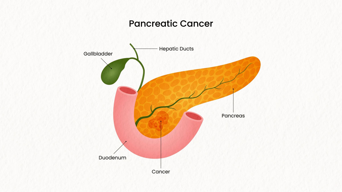 pancreatic-cancer