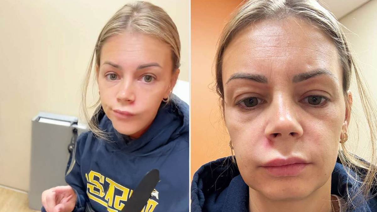 How Popping a Pimple Triggered Facial Paralysis: Exploring an Unusual Medical Case