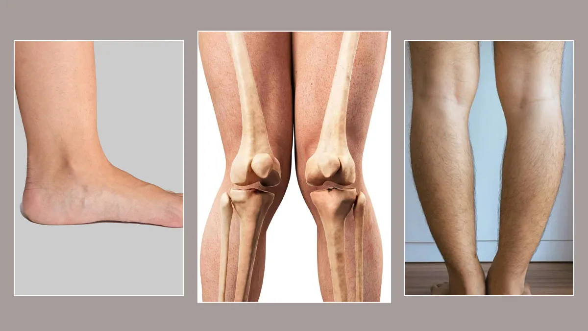 Flat Feet, Knock Knees, and Bow Legs in Kids: What’s Normal and When to Worry