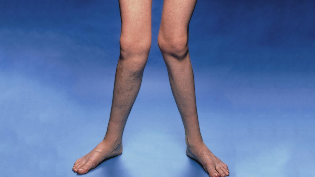 knock knees 3 - 2025-08-26T120952.751