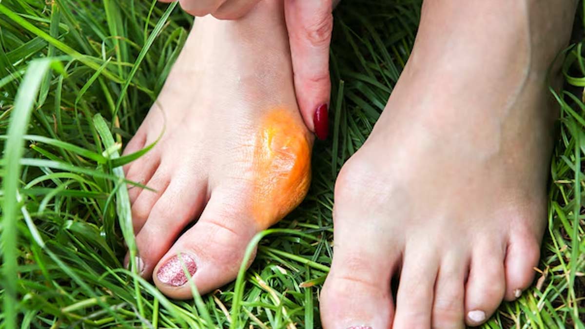 Why Women Are More At Risk Of Bunions - The Bony Bump On Big Toe