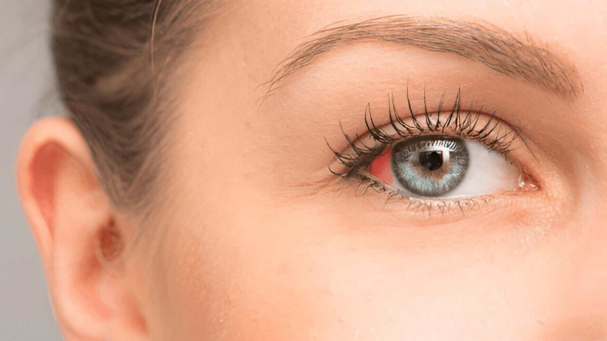 Blood Spot In The Eye: Common Causes And How To Prevent Recurrence