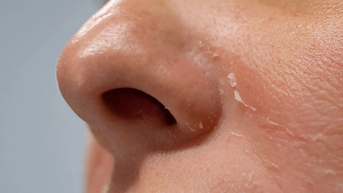 Struggling With Dry Skin Around Your Nose? Here’s How To Fix It Fast