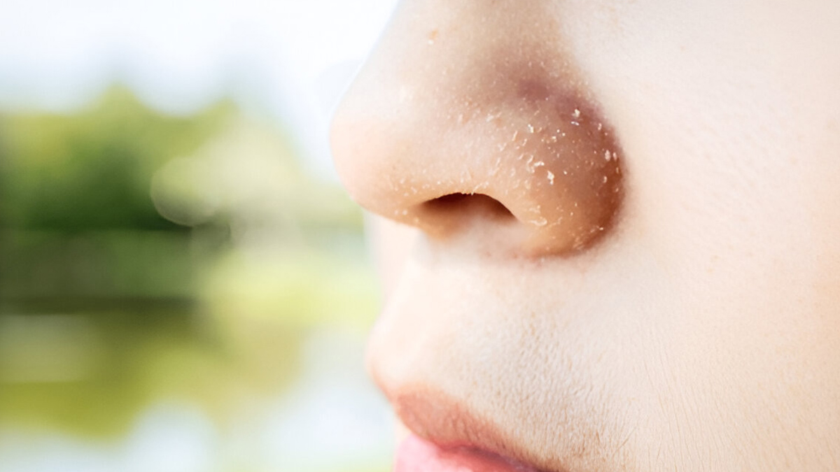 dry-skin-near-nose