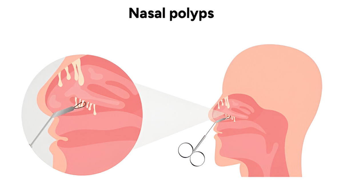 nasal-polyps