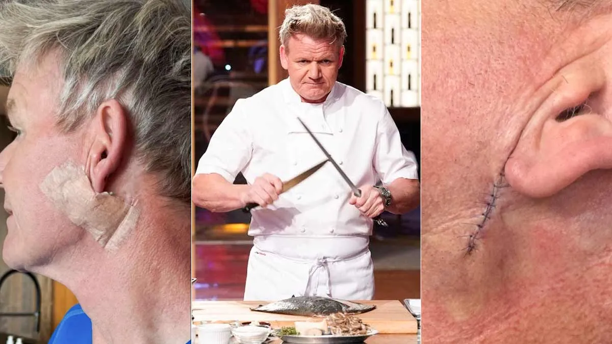 What Is Basal Cell Carcinoma? Exploring Chef Gordon Ramsay’s Skin Cancer Diagnosis After Surgery