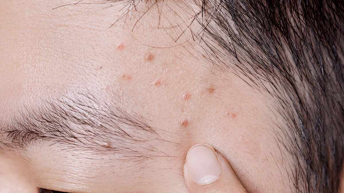 Fight the Friction: Home Remedies to Beat Acne Mechanica
