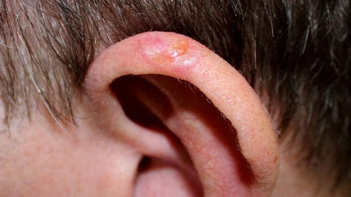 Basal Cell Carcinoma gordan ramsay cancer Basal Cell Carcinoma gordan ramsay