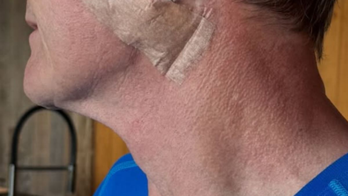 gordan ramsay skin cancer gordan ramsay skin cancer