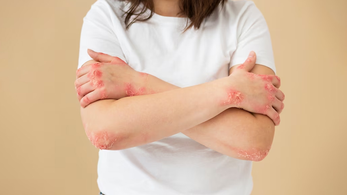 What Is Lupus and How Does It Affect the Body? Expert Explains