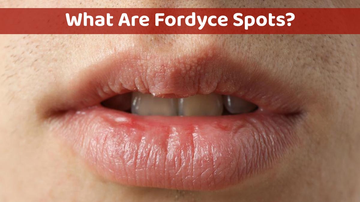 White Patches or Dots on Lips? Skincare Expert Shares Causes of Fordyce Spots