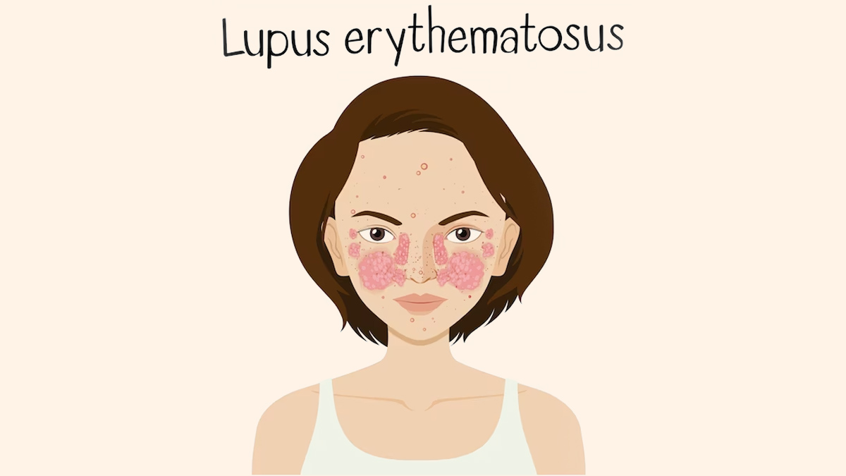 1-lupus