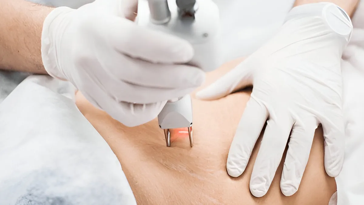 Laser Therapy For Removing Stretch Marks: How Effective Is The Procedure?