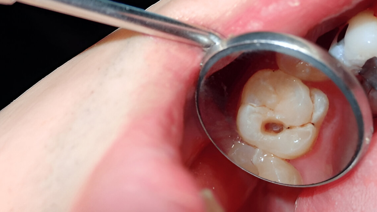 cavities-in-children