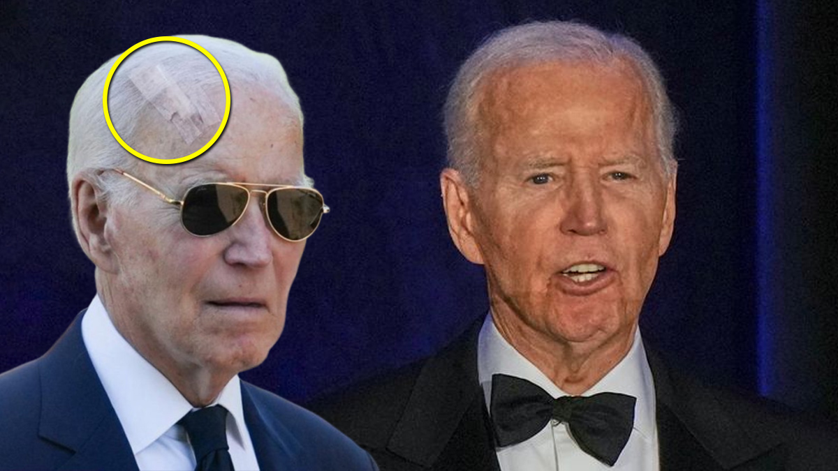 Joe Biden Undergoes Mohs Surgery To Remove Skin Cancer, Spotted With Big Head Wound