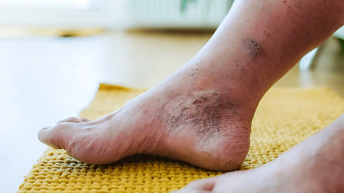 Why Non-Healing Foot Wounds Could Be A Vascular Emergency? Expert Explains