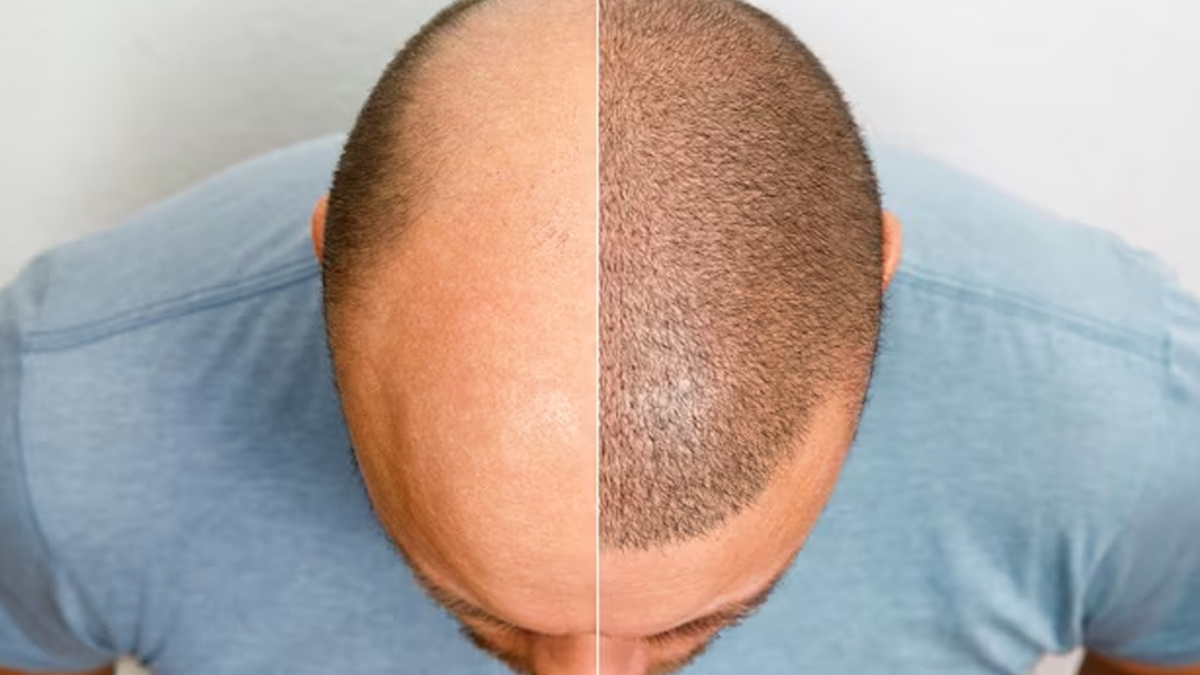 1-hair