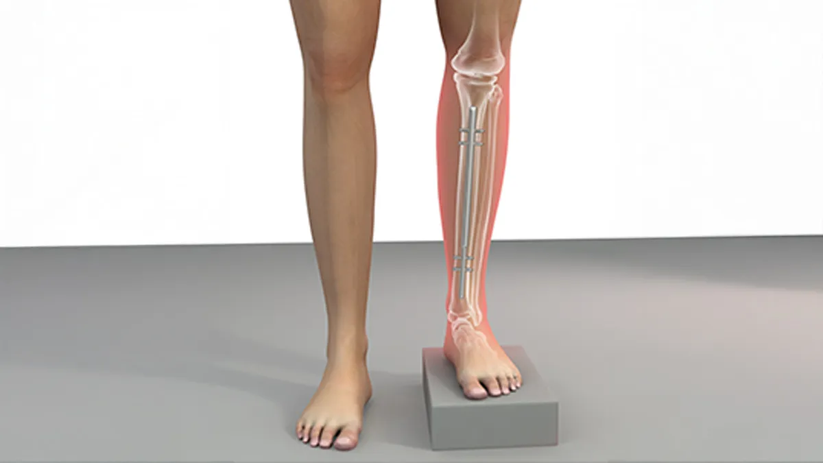 Would You Break Your Legs to Stand Taller? Exploring The Leg-Lengthening Surgery