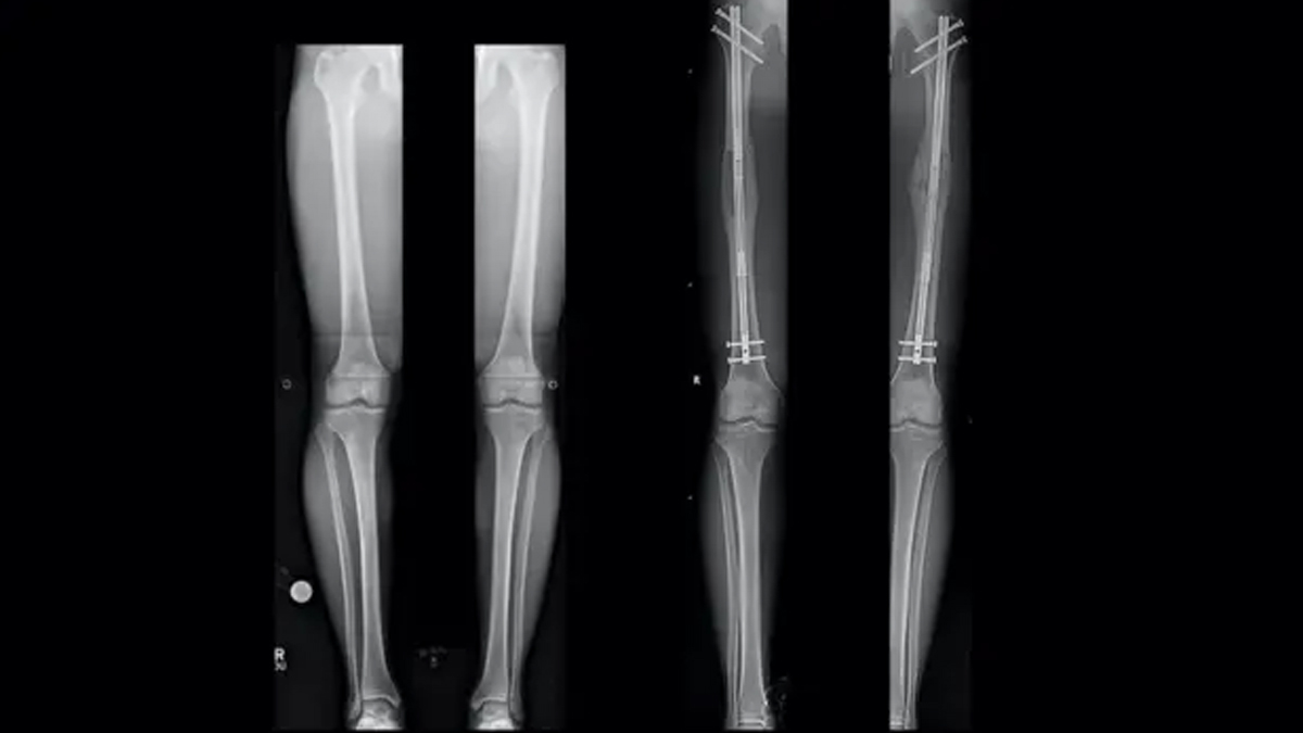 Leg-Lengthening Surgery process 1 - 2025-09-09T120911.388