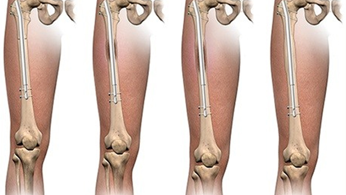 Leg Lengthening Surgery risks and complications 2 - 2025-09-09T120914.923