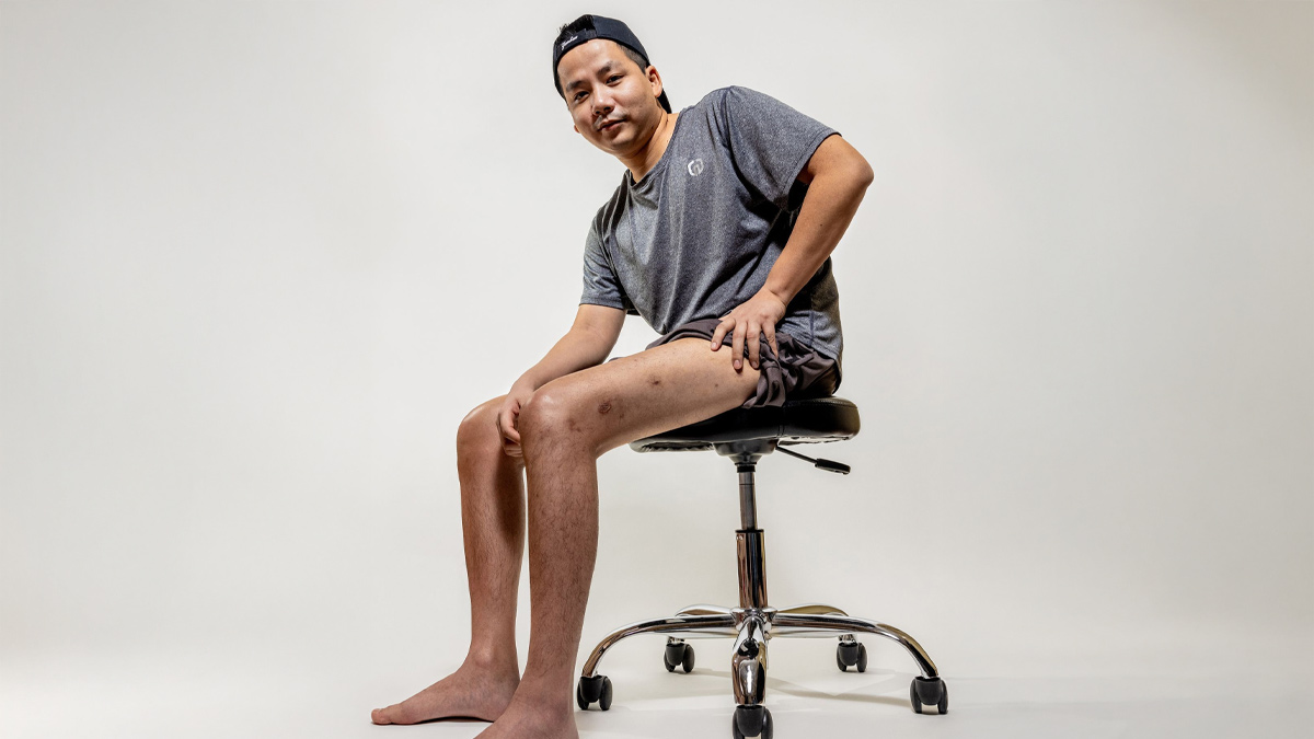 Leg-Lengthening Surgery 3 - 2025-09-09T120907.999