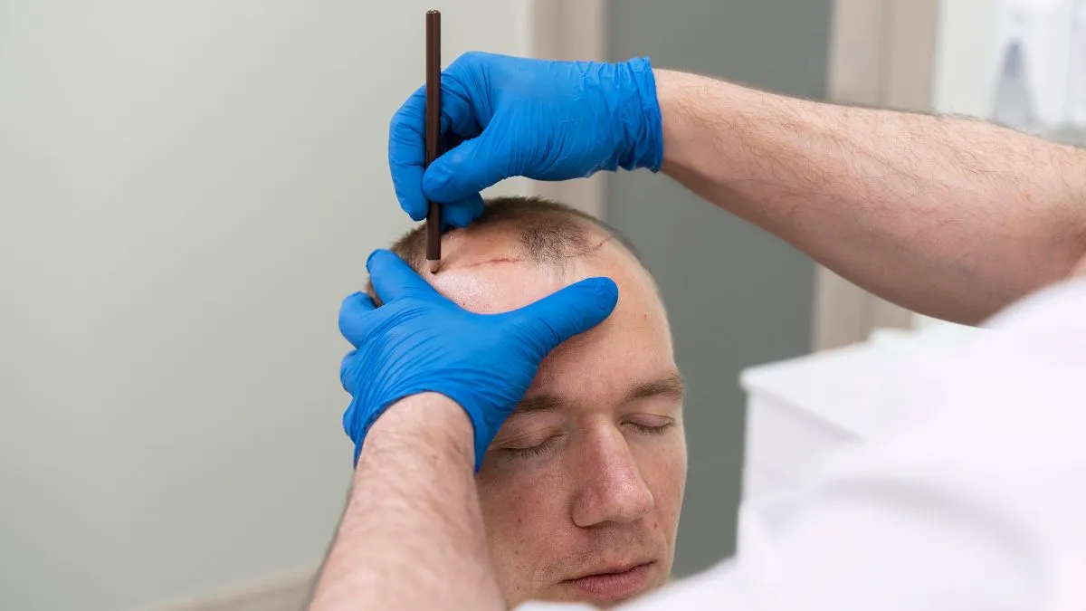 Direct Hair Transplantation (DHT): An Innovative Technology Changing the Game in Hair Restoration