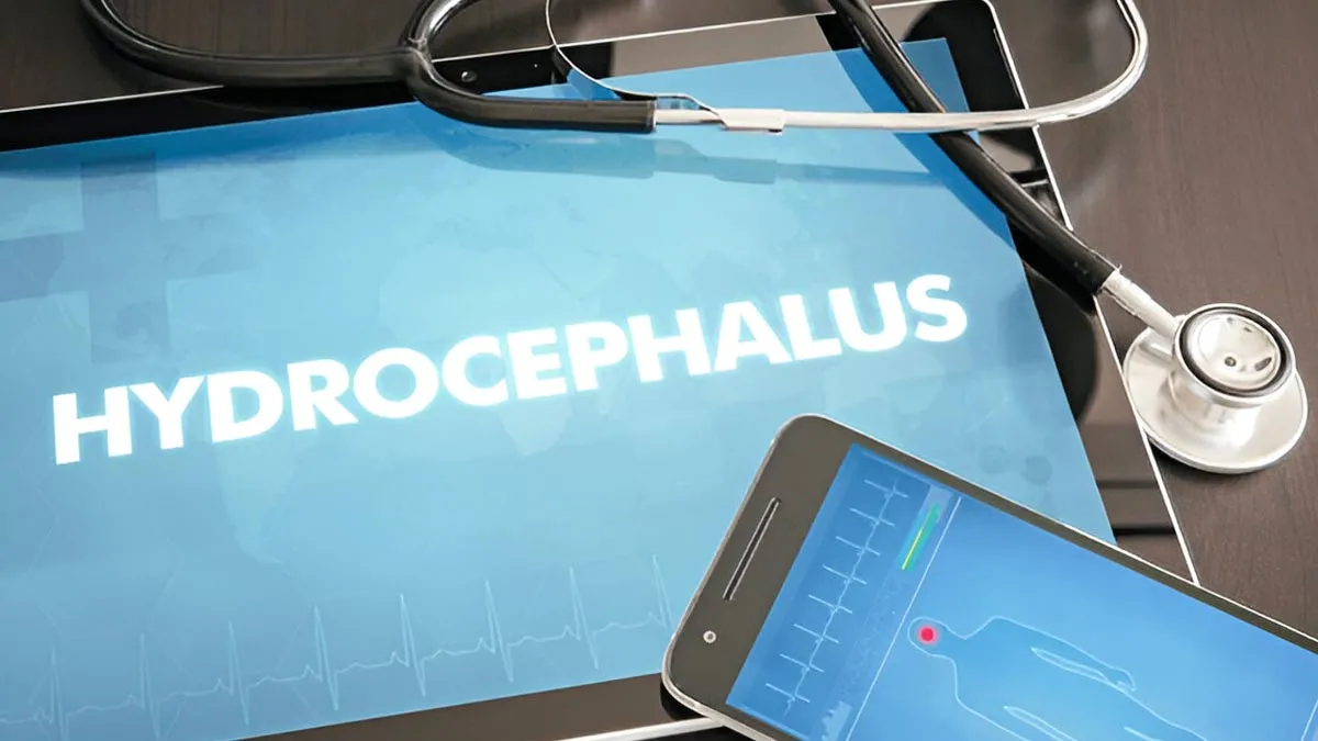 Hydrocephalus: Understanding The Dangers Of 'Water On The Brain' Across All Ages