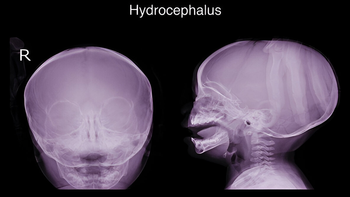 hydrocephalus