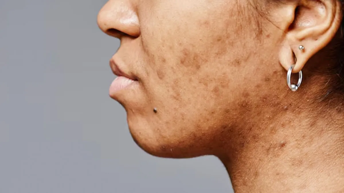 Dermatologist Shares 7 Skincare Mistakes That Make Your Dark Spots Worse