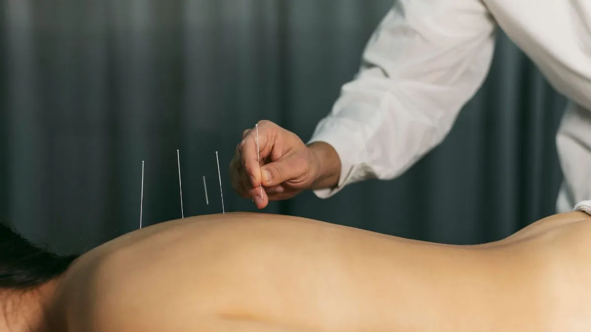Dry Needling: The Tiny Pinch with Big Relief