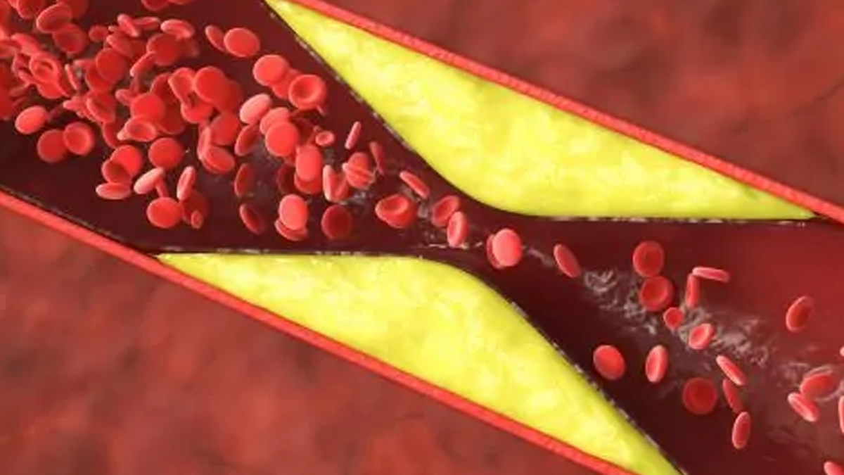 cholestrol in body 1 - 2025-09-15T123107.718