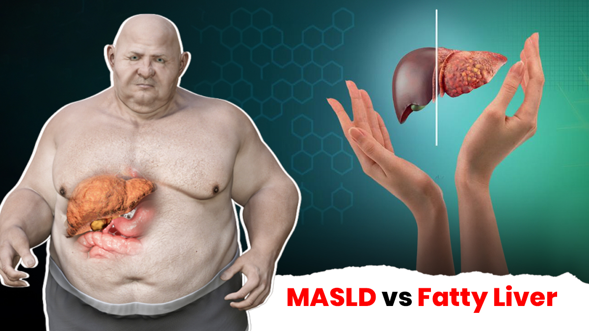 MASLD vs Fatty Liver: What Young Adults Need to Know About This Metabolic Condition