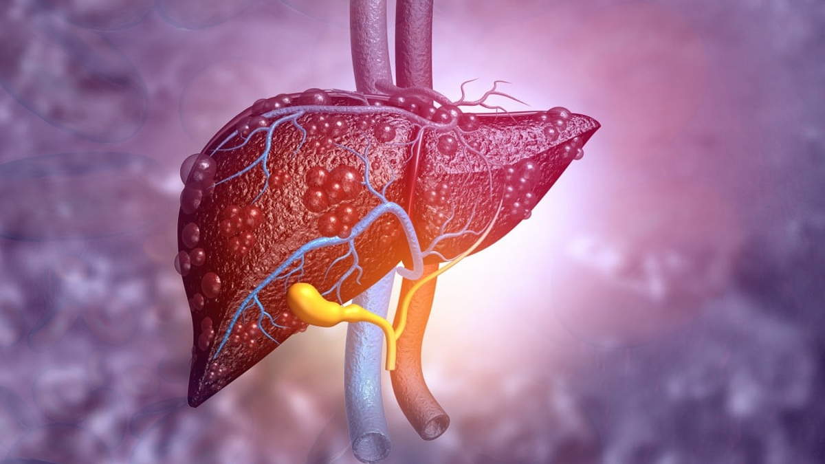 risks of masld 3 - 2025-09-16T102641.562