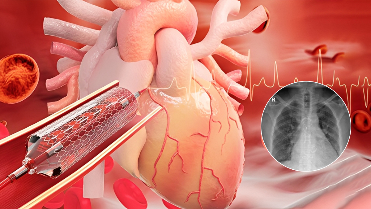 52-year-old Pune Man Survives Fourth Major Heart Surgery with Complex Bentall Procedure: Exploring The Surgery