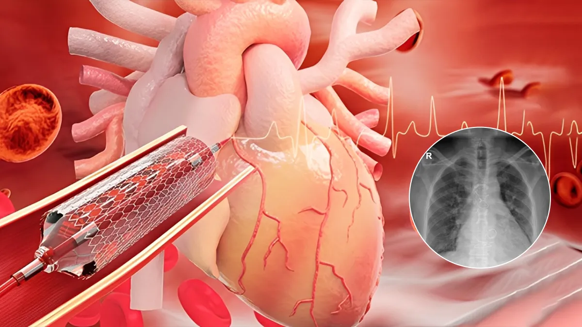 52-year-old Pune Man Survives Fourth Major Heart Surgery with Complex Bentall Procedure: Exploring The Surgery