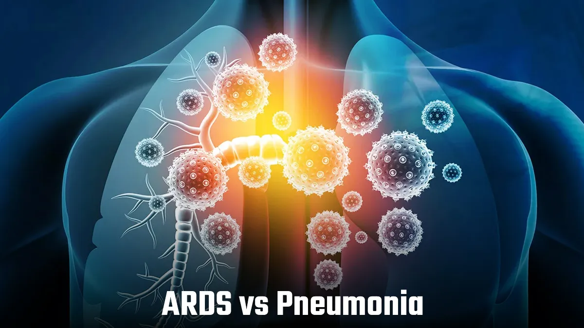 ARDS vs Pneumonia: Expert Shares Key Differences and What You Need to Know