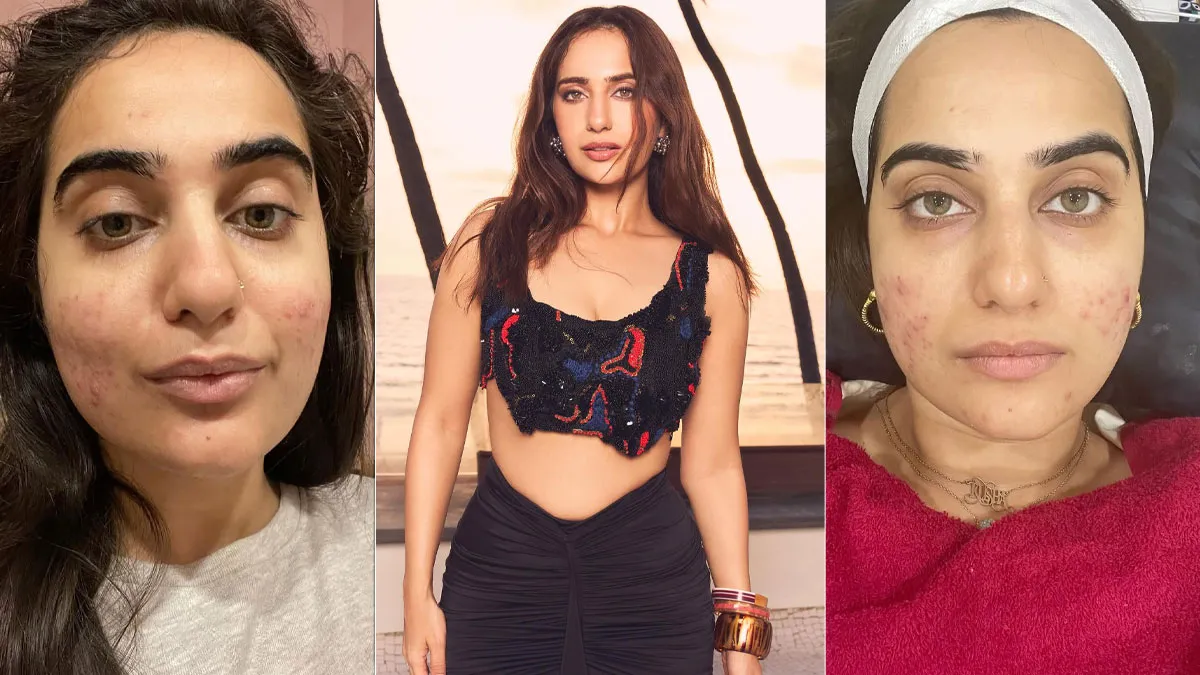 Can Side Sleeping Worsen Acne? Here’s How Kusha Kapila Managed Her Skin Acne, Bleeding and Sleep Troubles
