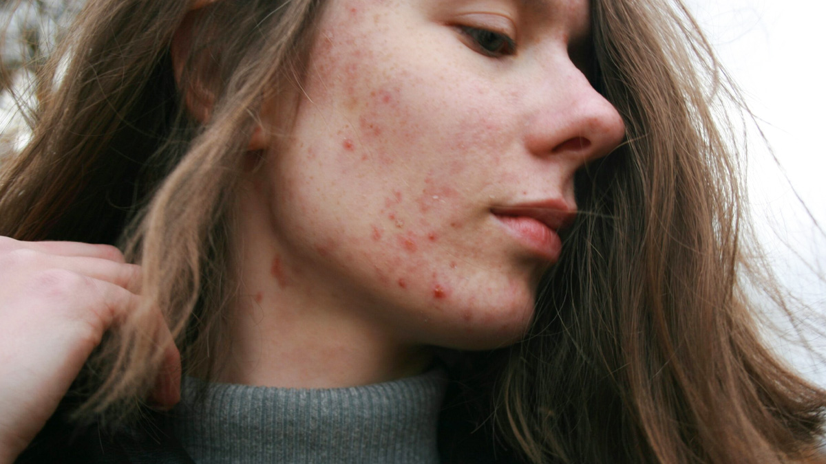 sleeping with acne 1 - 2025-10-01T154201.490