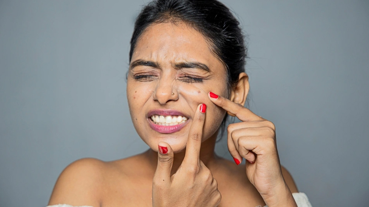 acne tips 2 - 2025-10-01T154159.317