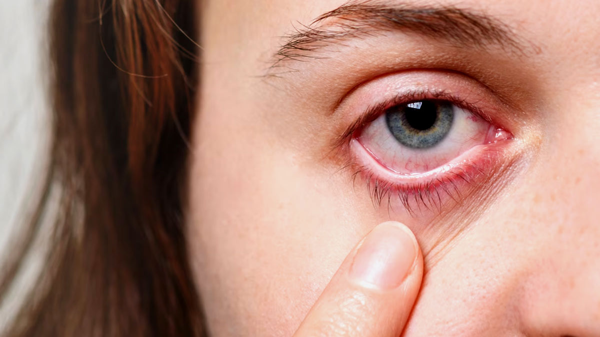 Monsoon Maladies: Your One Simple Fix for Chronic Dry Eyes, Says Expert