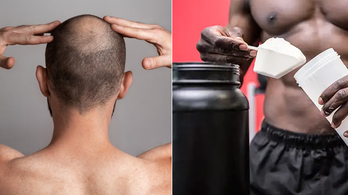 Does Creatine Cause Hair Loss? Dermatologist Answers Common Concerns