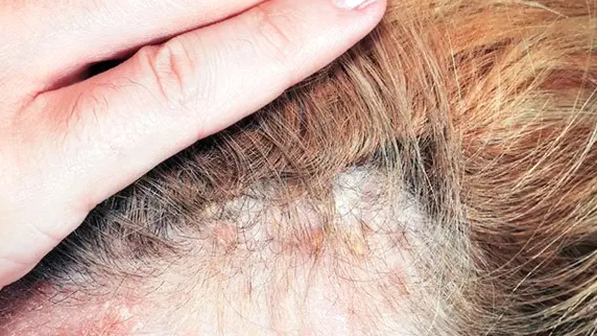 Could an Unhealthy Scalp Biome Cause Hair Loss? Find Out Here
